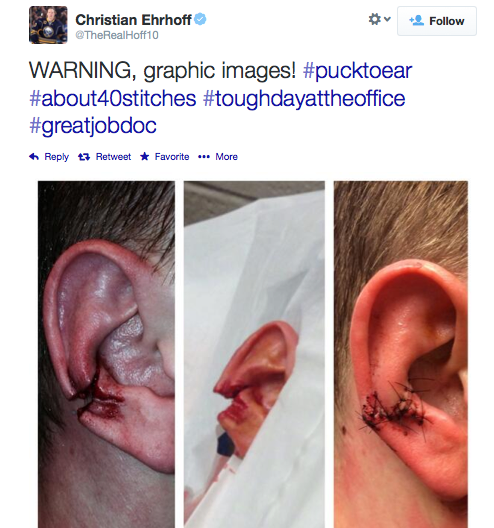 På Twitter visade han resultatet efter att ha täckt skott med örat.